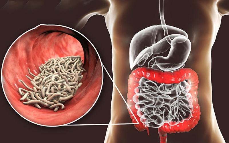 Lỵ Amíp là căn bệnh nhiễm trùng