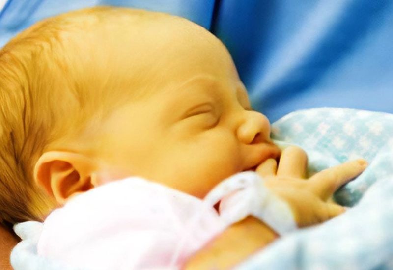Bệnh vàng da ở trẻ sơ sinh vô cùng phổ biến