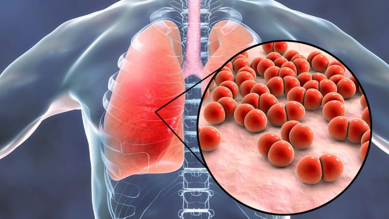 Các loại viêm phổi