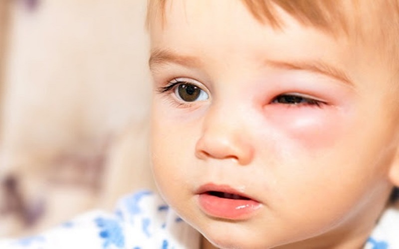 Các bé thường gặp những bệnh về mắt