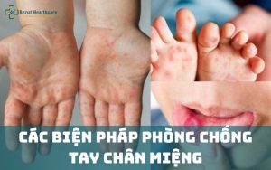 Cách phòng bệnh tay chân miệng